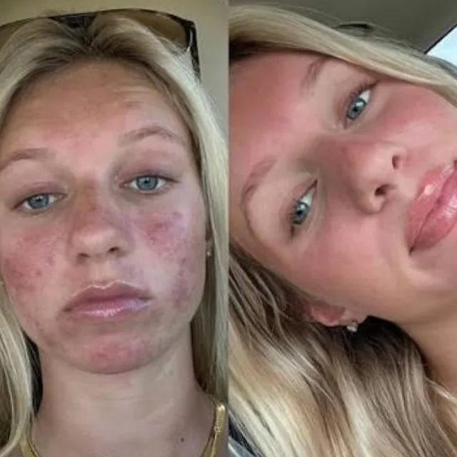 Antes e depois 1